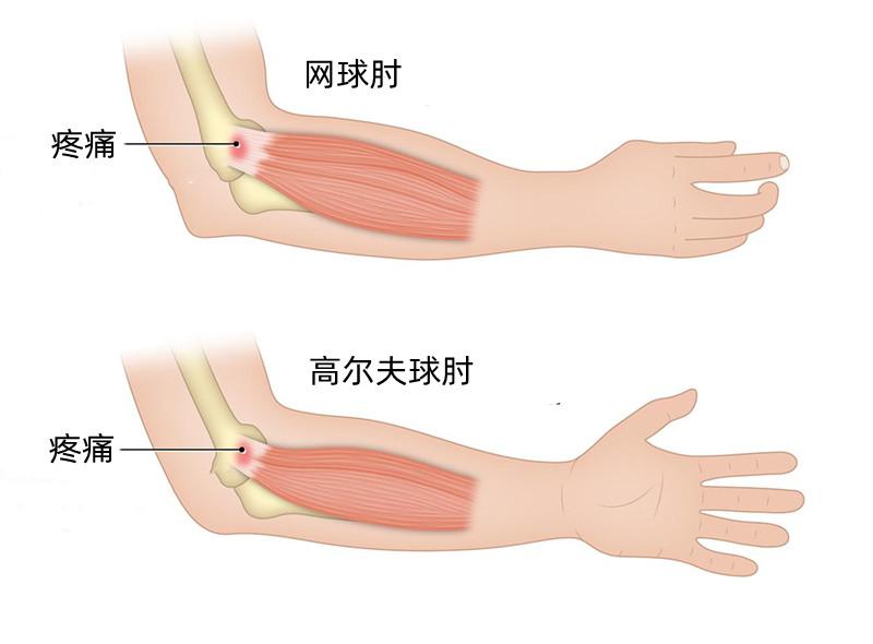 没有受伤胳膊肘疼痛，到底是高尔夫球肘，还是网球肘？